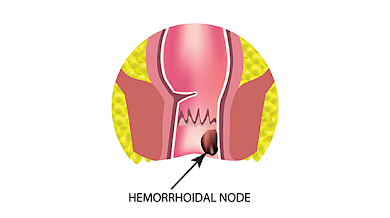 Hemoroid Tedavisi